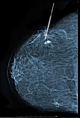 Stereotactic Biopsy of Breast