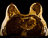 Breast Cancer,MRI