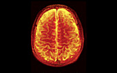 MRI of Normal Brain