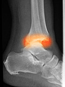 Fracture and Dislocation of the Ankle