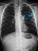 Pneumonia in 5 Year Old Boy