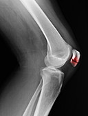 Patellar Fracture X-Ray