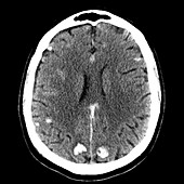 CT of Traumatic Brain Contusions