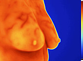Breast thermography