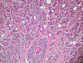 Invasive Ductal Carcinoma (LM)