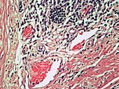 Reactive Lymph Node,Germinal Centers