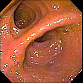 Pouchitis