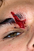 Facial Laceration