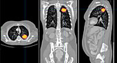 Lung Cancer,CT Scan