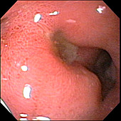Acute Duodenal Ulcer