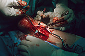 Achilles Tendon Surgery