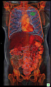 Lung Cancer,3D CT Scan