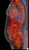 Lung Cancer,3D CT Scan