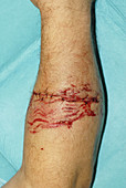 Sutured Dogbite Lacerations
