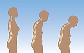 Progression of Osteoporosis