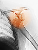 X-ray of Dislocated Shoulder