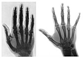 Early and Modern Hand X-rays