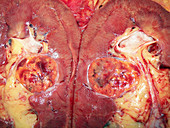 Kidney (Renal Cell Carcinoma)