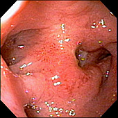 Acute and Chronic Duodenal Ulcer