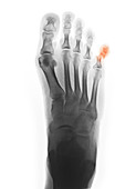X-ray Showing Fractured Pinky Toe