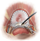 Suprapubic laparoscopic hernia repair