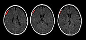 Subdural Hematoma in 6 Month Old,CT Scan