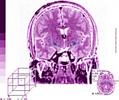 Parkinson's Disease