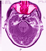 Sinusitis