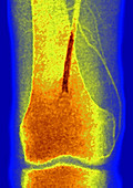 Popliteal Artery Embolism