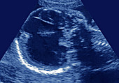 Hydrocephalic Fetus