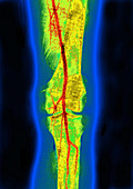 Femoral and Popliteal Arteries