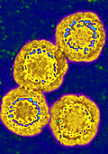 TEM of Hepatitis B Virus