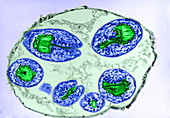 Hydatid Cysts (LM)