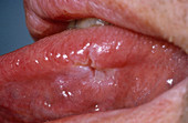 Meningovascular Syphilis