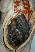 Gangrene of Intestines