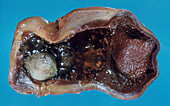 Inflamed Gallbladder with Gallstones