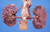 Polycystic Disease of Kidneys