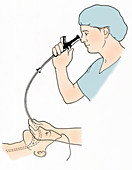 Illustration of Endoscopy