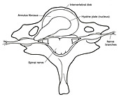 Illustration of Herniated Spinal Disk