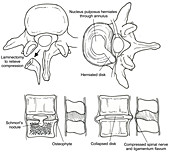 Illustration of Spinal Disk Pathologies