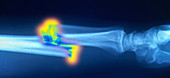 Broken Arm,X-ray