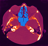 Normal MRI of Sinuses