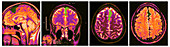 MRIs of Arachnoid Cyst