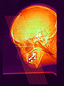 Normal X-ray of Sinuses