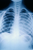 Lung Cancer,6-Year-Old Patient