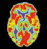 PET Scan of Normal Brain,1 of 2
