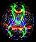 Normal Brain (Diffusion Tractography)