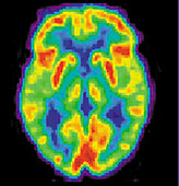PET Scan of 80-year-old Brain,2 of 2