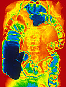 Large and Small Intestine,Barium X-ray