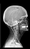 Deep Brain Stimulating Electrodes,X-ray